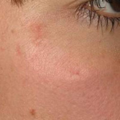 prepost_cicatrici_28
